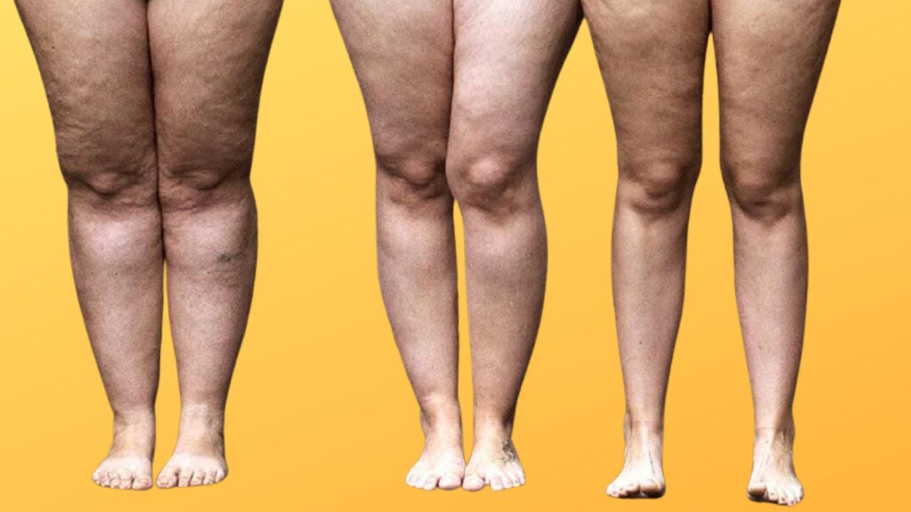 Lipedema: Conheça a condição médica que causa acúmulo de gordura nas pernas  e nádegas.