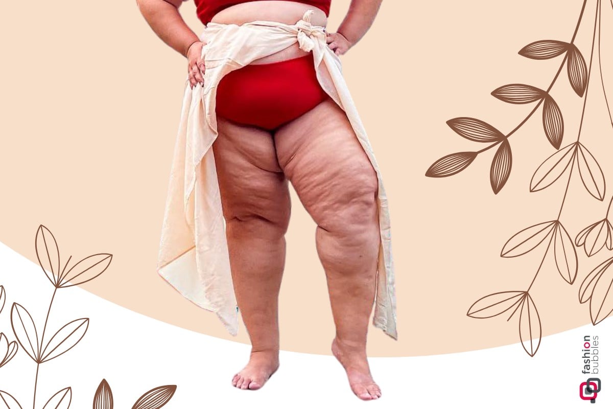 Lipedema: Conheça a condição médica que causa acúmulo de gordura nas pernas  e nádegas.