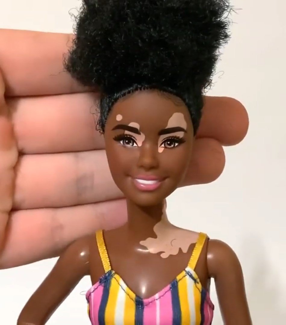 Barbie Fashionistas Vitiligo