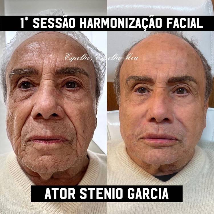 Antes e depois da 1ª sessão de harmonização facial do ator Stênio Garcia