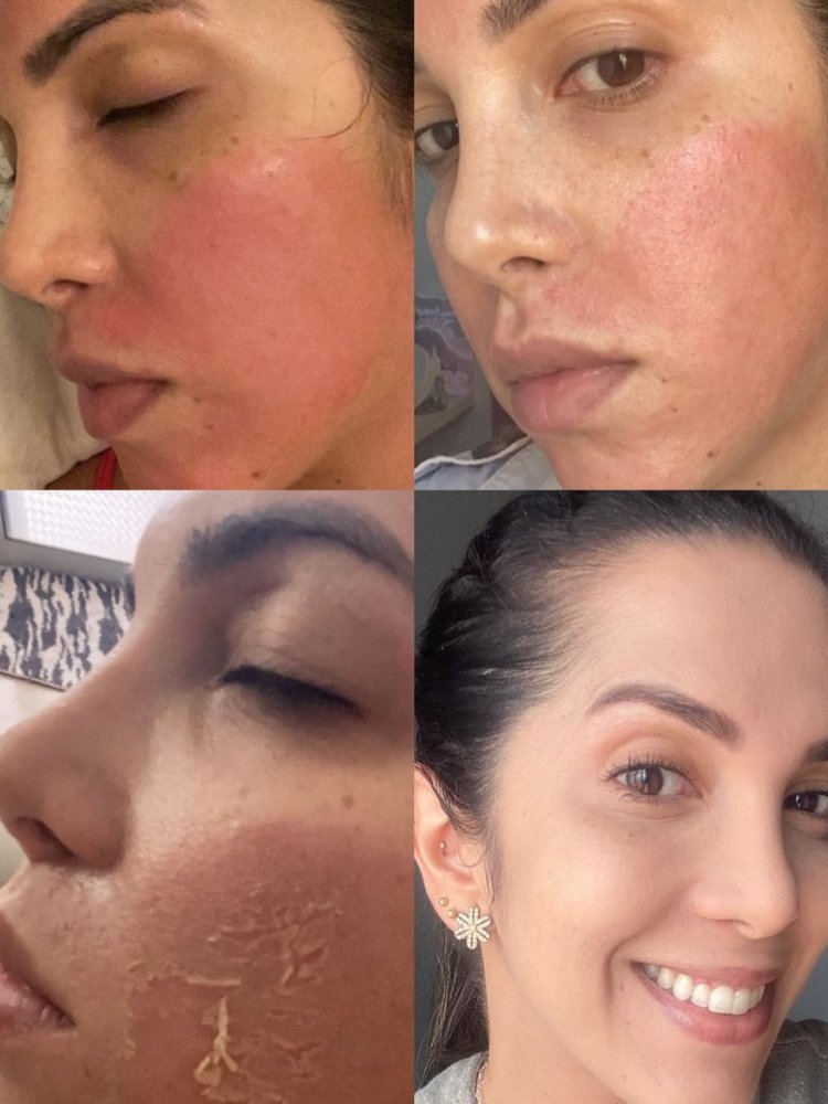 Montagem de 4 fotos de mulher de pele clara mostrando processo da pele após peeling: vermelhidão, descamação e pele renovada