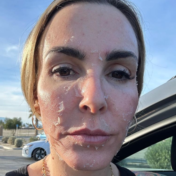 Mulher loira de pele clara com rosto descamado após peeling