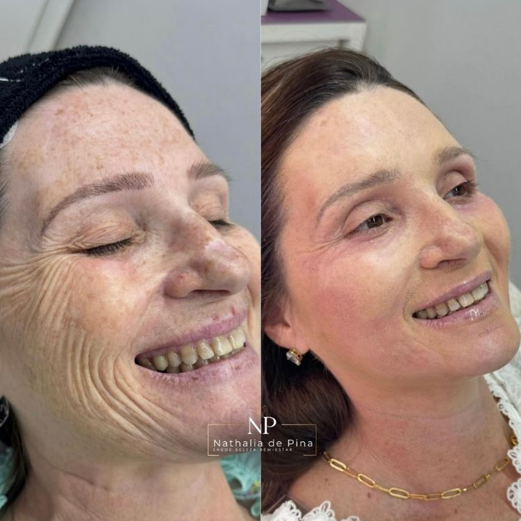 Antes e depois de peeling em mulher de pele clara. Antes, ela apresentava manchas e rugas no rosto, depois não mais
