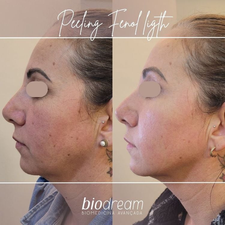 Montagem de antes e depois de mulher de pele clara que fez peeling de fenol light. Antes, ela apresentava manchas que sumiram após o procedimento