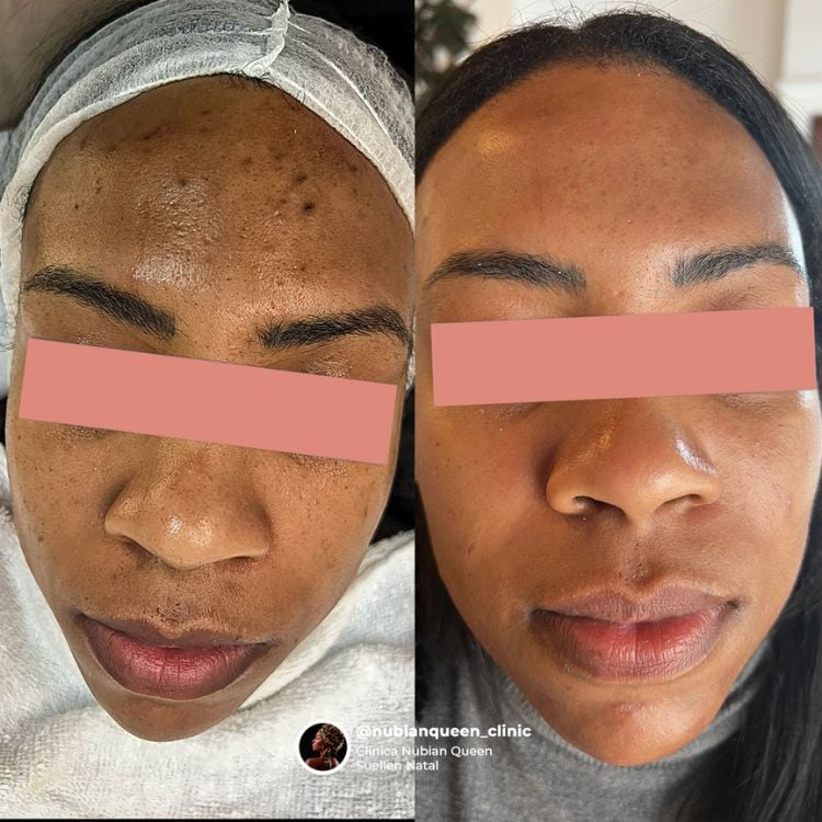 Montagem de antes e depois de pele de mulher negra, que apresentava manchas no rosto e, depois do peeling, elas sumiram