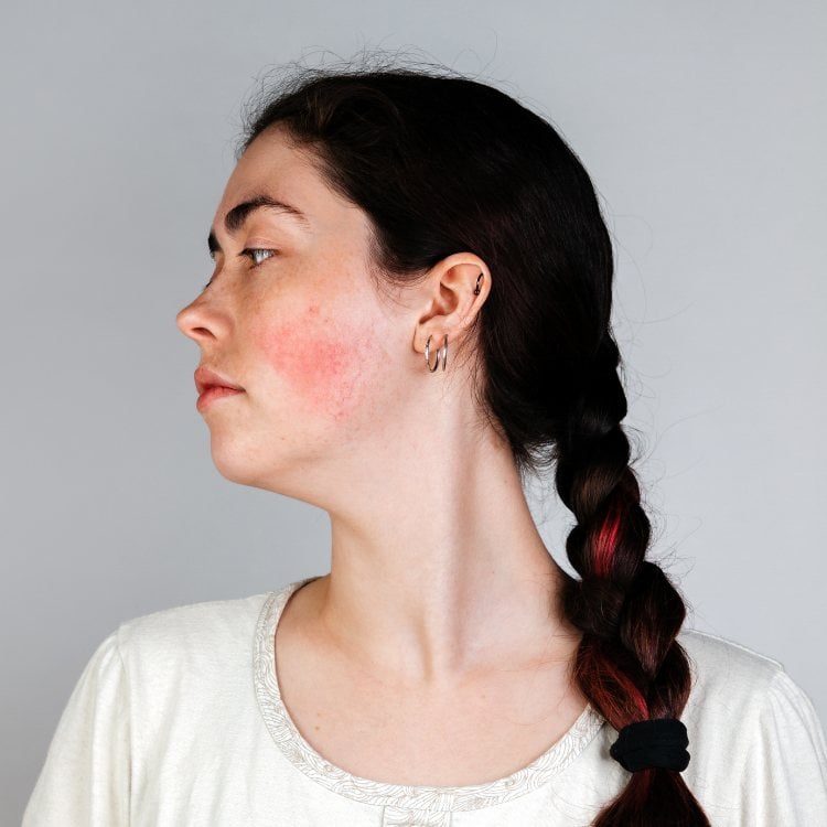 Mulher com rosácea leve no rosto. Ela usa camiseta, penteado de trança, brincos e piercing na orelha