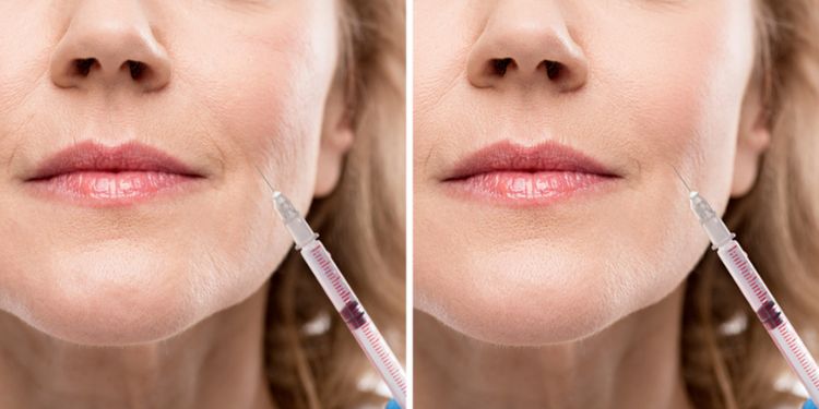 Procedimento de estética com injeção antes e depois