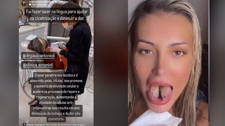 Após cirurgias, Andressa Urach afirma que está sentindo dor e desconforto no pós-operatório da língua.