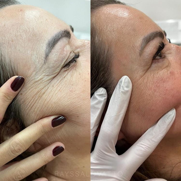 Foto de antes x depois de Sculptra. Em ambas as fotos, uma pessoa utiliza dois dedos para mostrar as linhas de expressão. Na primeira, há muito mais rugas e linhas do que na segunda foto.