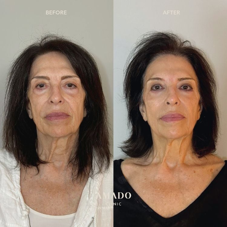 Fotos de antes x depois de Sculptra. Antes, a senhora de pele clara apresenta muitas rugas e flacidez. Depois, a pele tem mais viço e menos linhas de expressão.