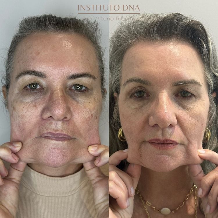 Foto de antes x depois de Sculptra. Na primeira imagem, a sehora de pele clara apresenta manchas na pele e segura duas pontas da bochecha para baixo, demonstrando a flacidez. Na segunda foto, ela aparece sem manchas, talvez maquiada, e puxando as bochechas, que estão mais "coladas" ao rosto 