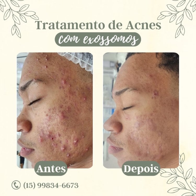 Montagem de fundo amarelo com antes e depois de homem tratando acne com exossomos, com muita acne e o depois com menos e menos inflamadas