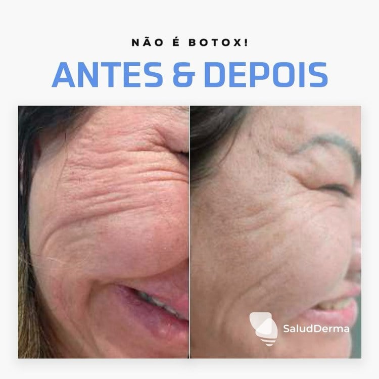 Montagem de fundo bege com foto de antes e depois de rugas de uma senhora, que diminuíram com o uso de exossomos