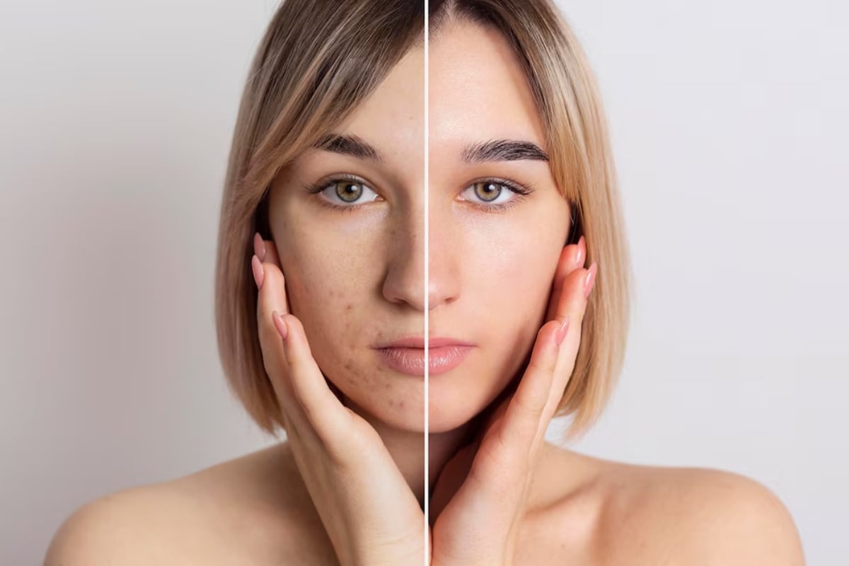 Mulher de pele clara com linha no meio do rosto definindo o antes (com acne e manchas) e depois (sem manchas)